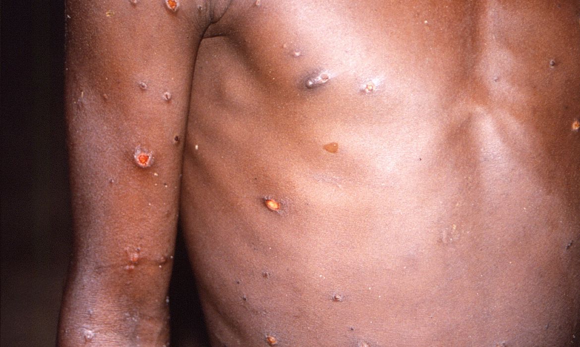 2022-05-19t154353z_1_lynxnpei4i0ra_rtroptp_4_health-monkeypox-country