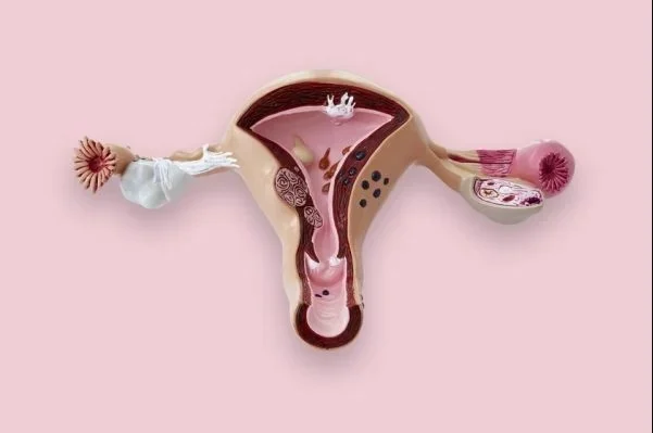 Desenho-utero-com-focos-do-cancer-no-colo-do-utero