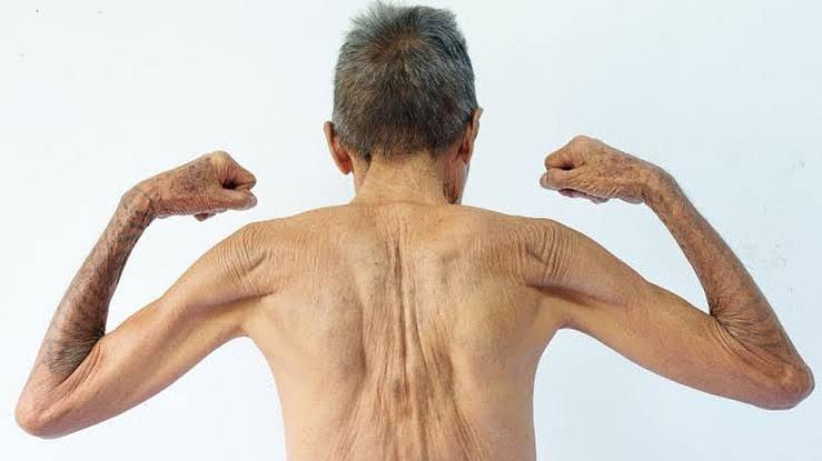Perda de massa, força e fragilidade são característica da sarcopenia