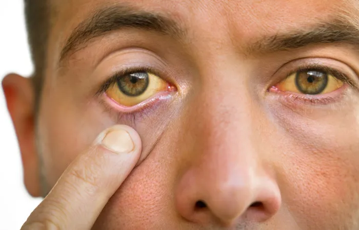 olhos amarelados caracterizam estágio avançado da doença