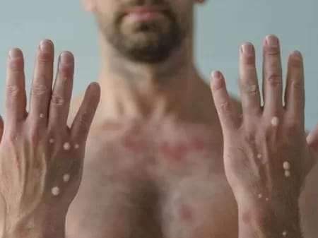 A manifestação na pele é chamada de papulovesicular uniforme