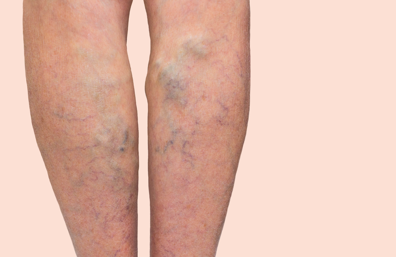 Varicose veins on a female legs